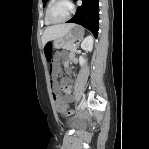 Closed loop small bowel obstruction due to trans-omental herniation (Radiopaedia 35593-37109 C 42).jpg
