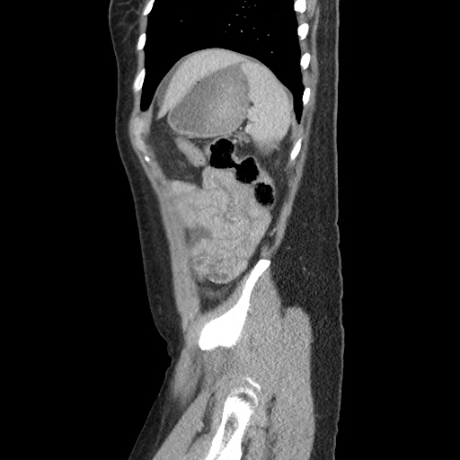 File:Closed loop small bowel obstruction due to trans-omental herniation (Radiopaedia 35593-37109 C 54).jpg