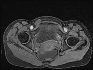 Closed loop small bowel obstruction in pregnancy (MRI) (Radiopaedia 87637-104031 F 67).jpg