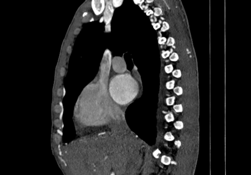 Coarctation of aorta with aortic valve stenosis (Radiopaedia 70463-80574 B 17).jpg