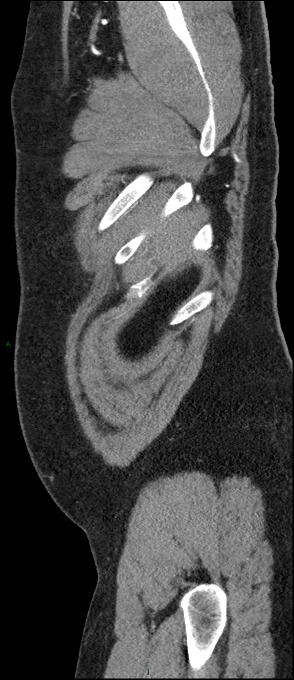 Coarctation of the aorta (Radiopaedia 74632-88521 C 14).jpg