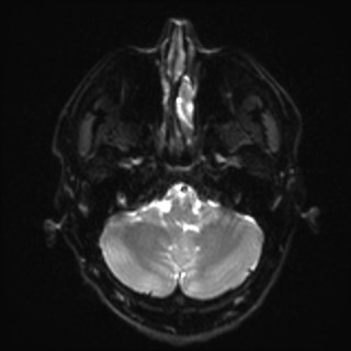 Cochlear incomplete partition type III associated with hypothalamic hamartoma (Radiopaedia 88756-105498 Axial DWI 8).jpg
