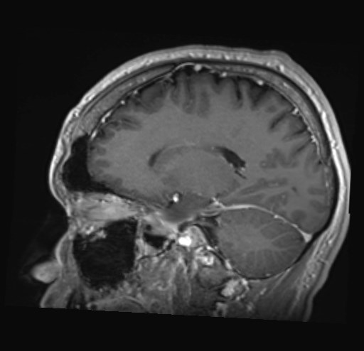 Cochlear incomplete partition type III associated with hypothalamic hamartoma (Radiopaedia 88756-105498 Sagittal T1 C+ 21).jpg