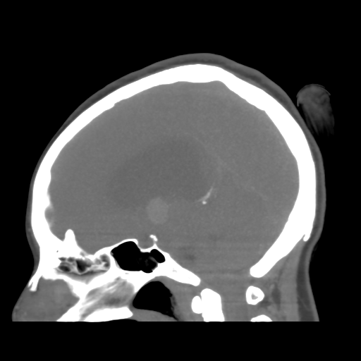 File:Colloid cyst (resulting in death) (Radiopaedia 33423-34499 B 28).png