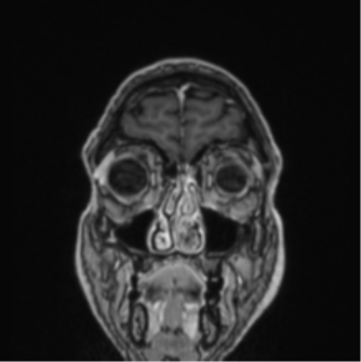 File:Colloid cyst of the third ventricle (Radiopaedia 86571-102662 Coronal T1 C+ 81).png