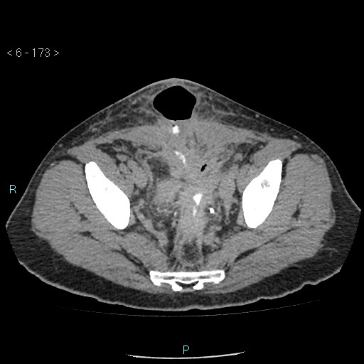 Colo-cutaneous fistula (Radiopaedia 40531-43129 A 72).jpg