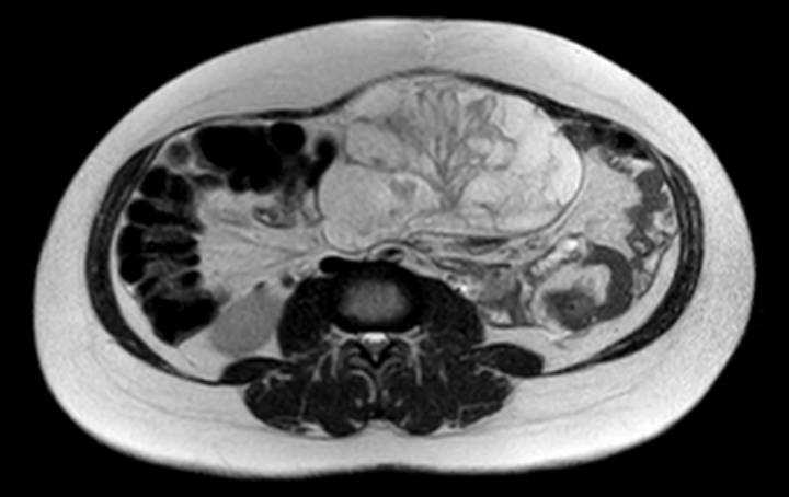 Colon adenocarcinoma with Krukenberg tumors, advanced pregnancy (Radiopaedia 67279-76645 Axial T2 41).jpg