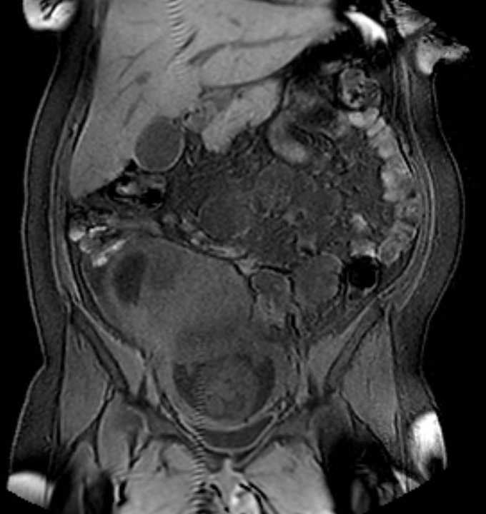 Colon adenocarcinoma with Krukenberg tumors, advanced pregnancy (Radiopaedia 67279-76645 E 38).jpg