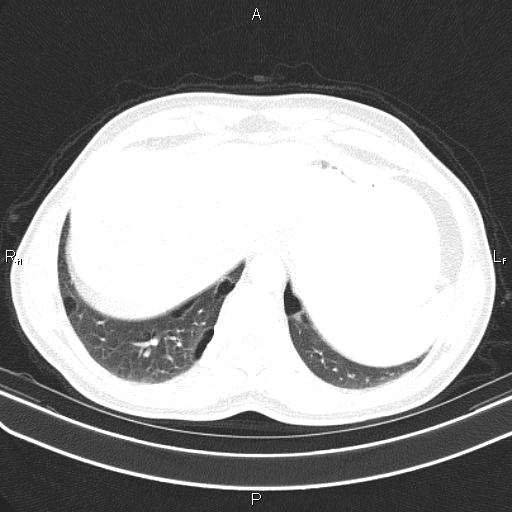 File:Colon cancer (Radiopaedia 85663-101443 Axial lung window 55).jpg