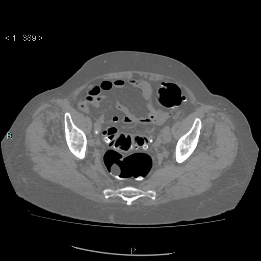 Colonic lipomas (Radiopaedia 49137-54244 Axial bone window 173).jpg