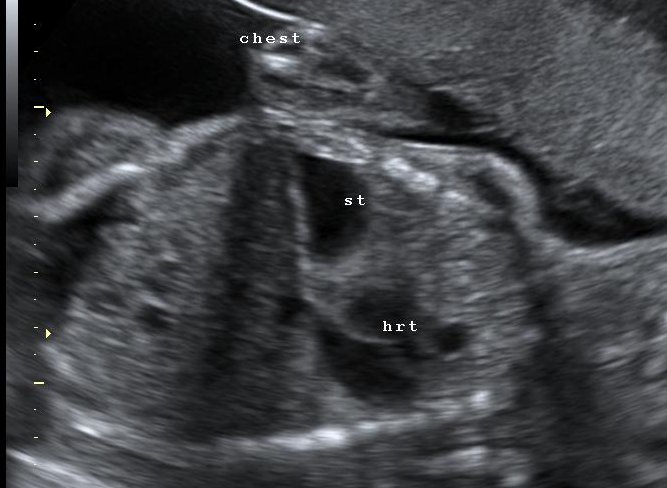 File:Congenital diaphragmatic hernia (Radiopaedia 36006).jpg