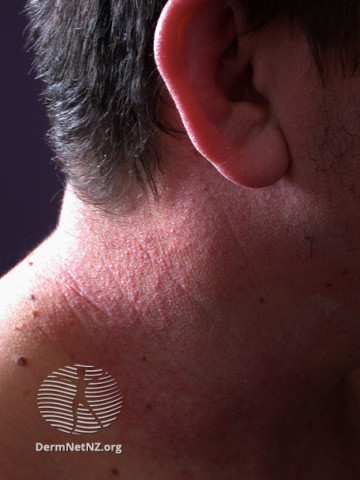 File:Contact allergic dermatitis (DermNet NZ dermatitis-acd-face-2426).jpg