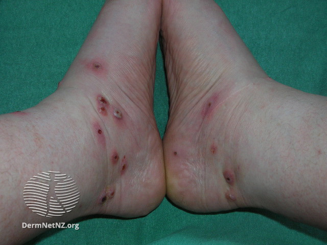 File:Infected leech bites (DermNet NZ bacterial-leech-bites).jpg