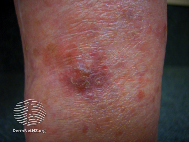 Intraepidermal carcinoma (DermNet NZ lesions-scc-in-situ-2921).jpg
