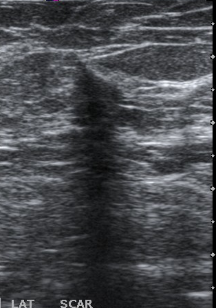 File:Knife wound on breast ultrasound (Radiopaedia 18765).png