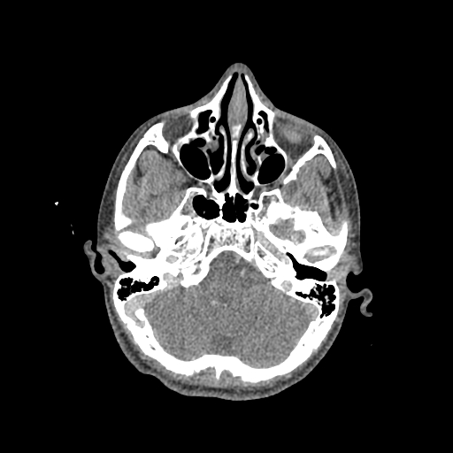 Nasal pyogenic granuloma (lobular capillary hemangioma) (Radiopaedia 85536-101244 C 85).jpg