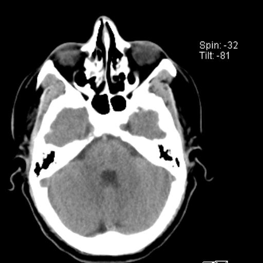 File:Nasolabial cyst (Radiopaedia 28401-28650 Axial non-contrast 5).jpg
