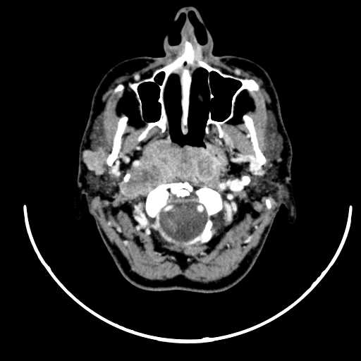 File:Nasopharyngeal carcinoma - infiltrating the clivus (Radiopaedia 62583-70875 Axial Post contrast 19).jpg