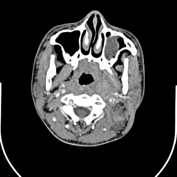 Nasopharyngeal carcinoma with skull base invasion (Radiopaedia 53415-59705 A 68).jpg
