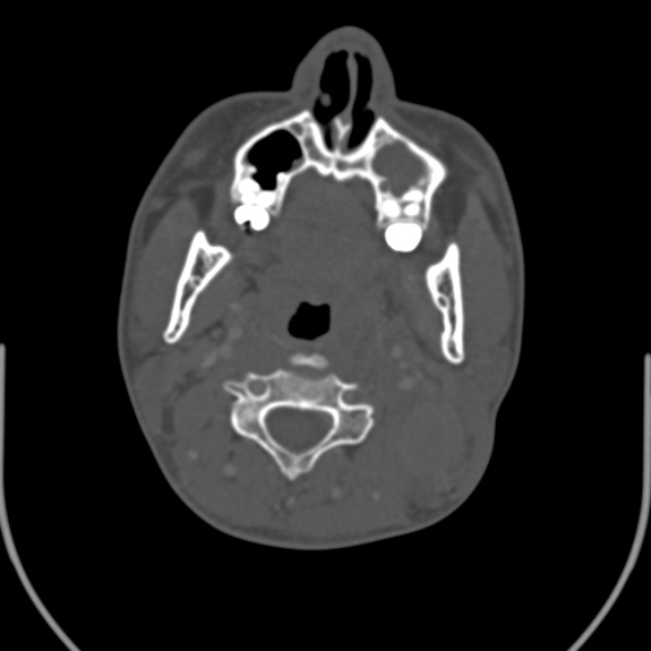 Nasopharyngeal carcinoma with skull base invasion (Radiopaedia 53415-59705 Axial bone window 83).jpg