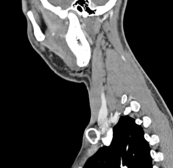 Nasopharyngeal carcinoma with skull base invasion (Radiopaedia 53415-59705 C 13).jpg