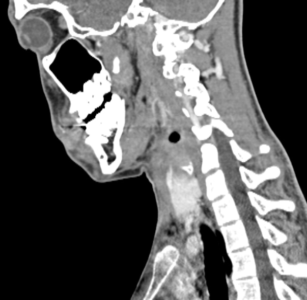 Nasopharyngeal carcinoma with skull base invasion (Radiopaedia 53415-59705 C 25).jpg
