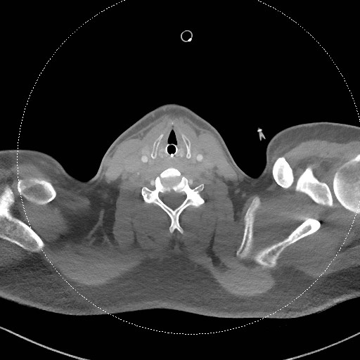 Neck CT angiogram (intraosseous vascular access) (Radiopaedia 55481-61945 B 151).jpg