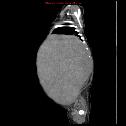 File:Neonatal neuroblastoma (Radiopaedia 9564-10223 C 32).jpg