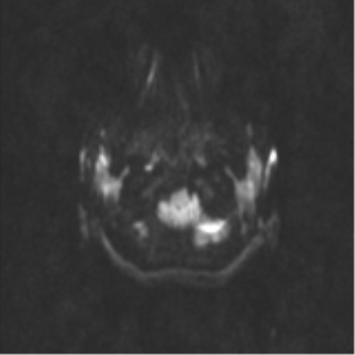 Neurenteric cyst (Radiopaedia 58641-65837 Axial DWI 38).png
