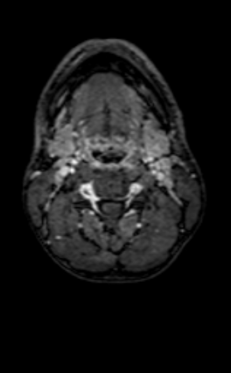 Neuro-Behçet disease (Radiopaedia 90112-107294 Axial T1 C+ 255).jpg
