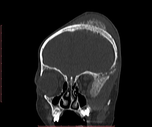 File:Neuroblastoma skull metastasis (Radiopaedia 56053-62683 Coronal bone window 9).jpg