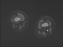 File:Neuroblastoma with bone metastases (Radiopaedia 67080-76414 Axial STIR 13).jpg