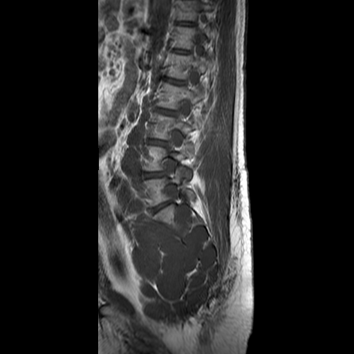 File:Neurofibromatosis type 1- extensive spinal involvement and Christmas tree sign (Radiopaedia 60610-68332 Sagittal T1 6).jpg