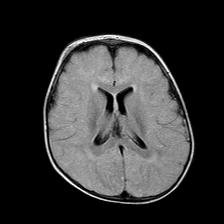 File:Neurofibromatosis type 1 (Radiopaedia 30089-30671 Axial FLAIR 14).jpg