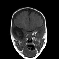 File:Neurofibromatosis type 1 (Radiopaedia 30089-30671 Coronal T1 8).jpg
