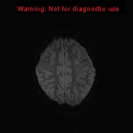 File:Neurofibromatosis type 1 with optic nerve glioma (Radiopaedia 16288-15965 Axial DWI 54).jpg