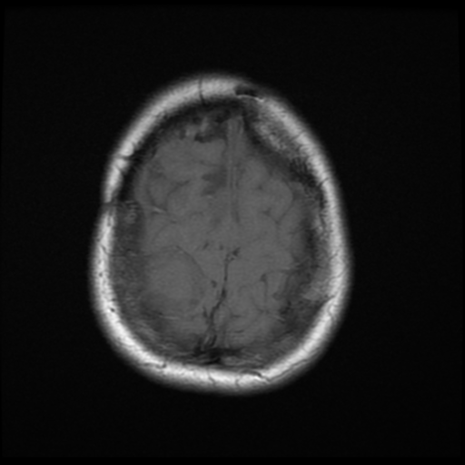 File:Neurofibromatosis type 2 (Radiopaedia 45229-49247 Axial T1 20).png