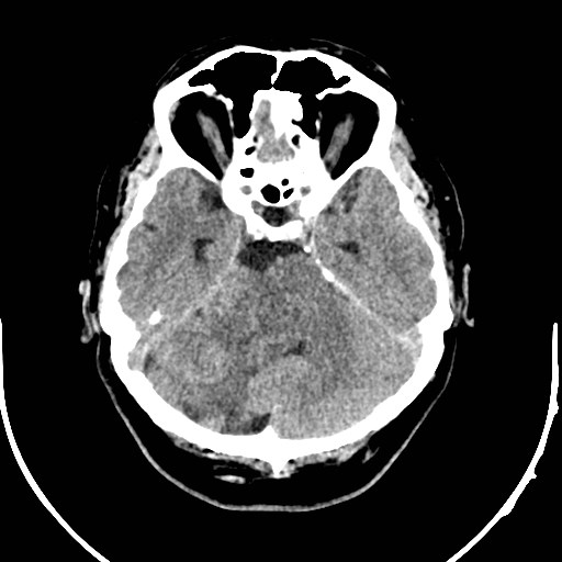Neurofibromatosis type 2 (Radiopaedia 79097-92047 Axial non-contrast 17).jpg