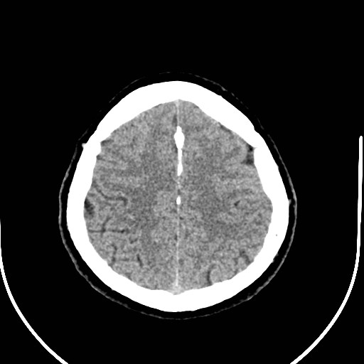 Neurofibromatosis type 2 (Radiopaedia 79097-92047 Axial non-contrast 49).jpg