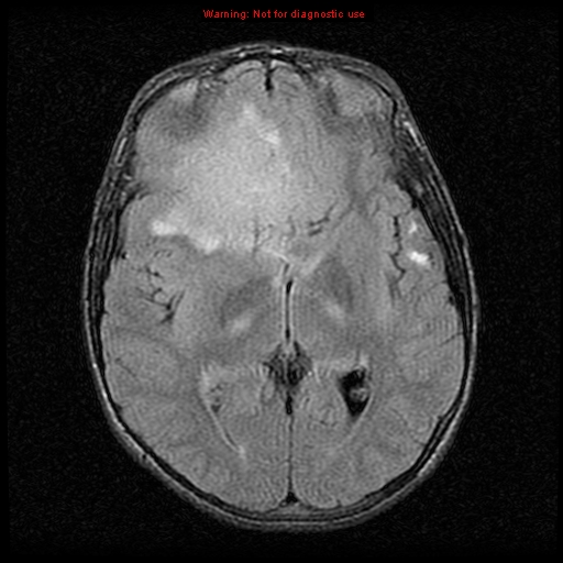 File:Neurofibromatosis type 2 (Radiopaedia 8953-9730 Axial FLAIR 13).jpg