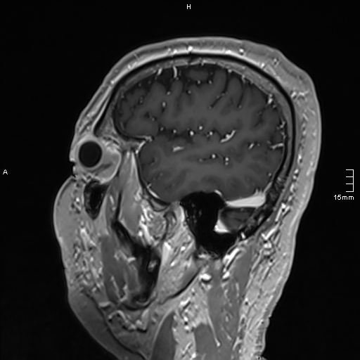 Neurosarcoidosis - involvement of the mesial temporal lobes (Radiopaedia 67429-76820 Sagittal T1 C+ 37).jpg