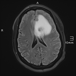 File:Neurotoxoplasmosis - concentric target sign (Radiopaedia 70644-80784 Axial FLAIR 13).jpg