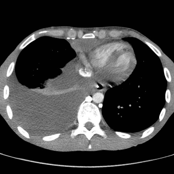 File:Non-Hodgkin lymphoma involving lung (Radiopaedia 29094-29470 B 51).jpg