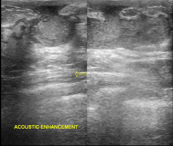 File:Non-lactating breast abscess (Radiopaedia 31045-31754 E 1).jpg