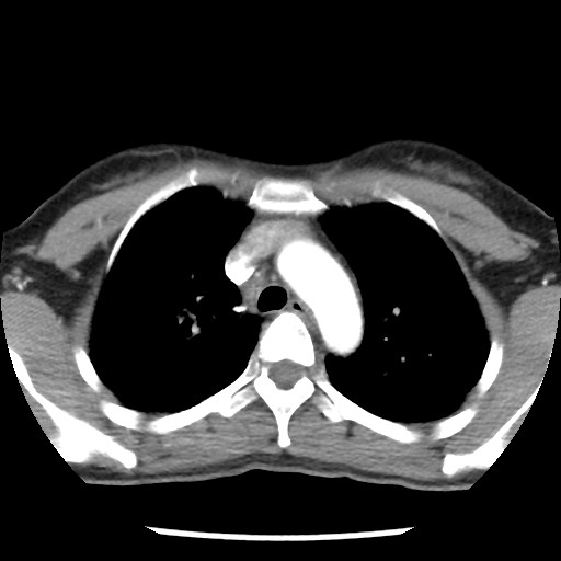 File:Non-small cell lung cancer with miliary metastases (Radiopaedia 23995-24193 A 16).jpg