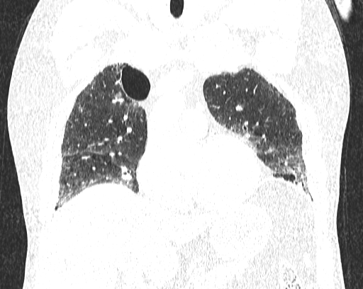 Non-specific interstitial pneumonia (NSIP) (Radiopaedia 68599-78228 Coronal lung window 33).jpg