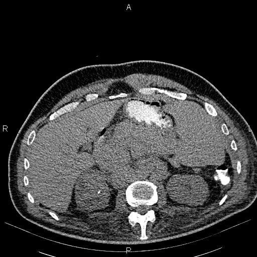 File:Non Hodgkin lymphoma in a patient with ankylosing spondylitis (Radiopaedia 84323-99621 Axial non-contrast 32).jpg