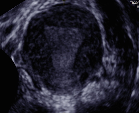 File:Normal 3D uterus (Radiopaedia 34301-35588 C 1).jpg