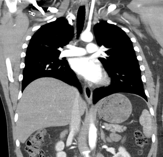 File:Normal CTA thorax (non ECG gated) (Radiopaedia 41750-44704 B 48).png