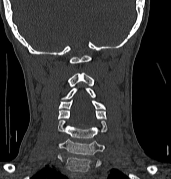 File:Normal CT cervical spine - 12-year-old (Radiopaedia 55352-61775 Coronal bone window 134).jpg